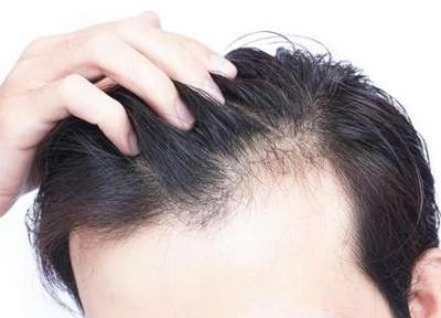با این 10 روش ساده موی ریخته شده را به سرتان برگردانید